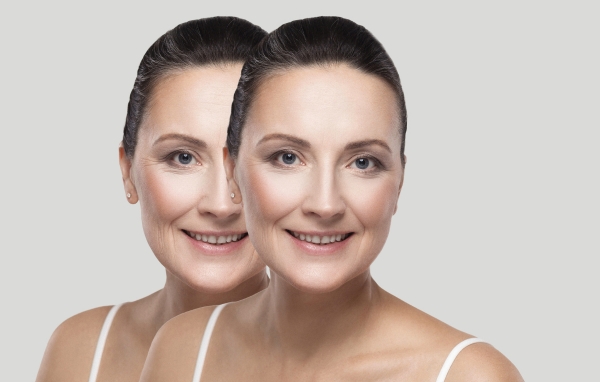 Botox Before and After Transformations