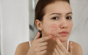 Acne Scar Treatment