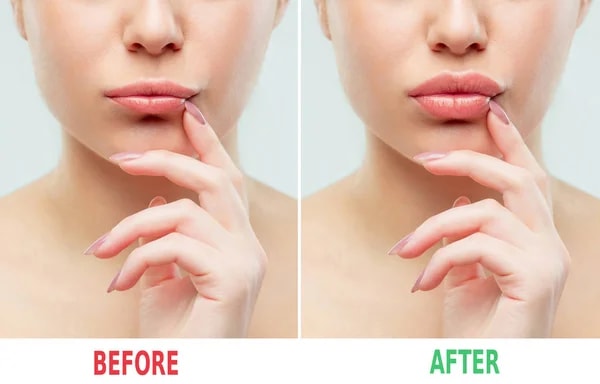 Before and after images for lip filler treatment.