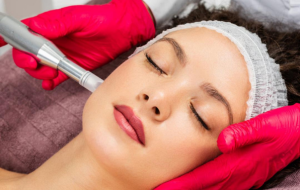 microneedling 05