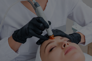 microneedling facial 01