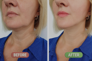 before and after botox 01