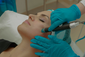 microneedling treatment