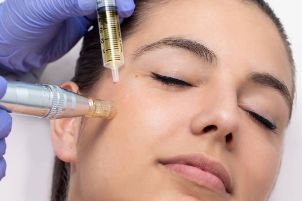 mesotherapy face 02