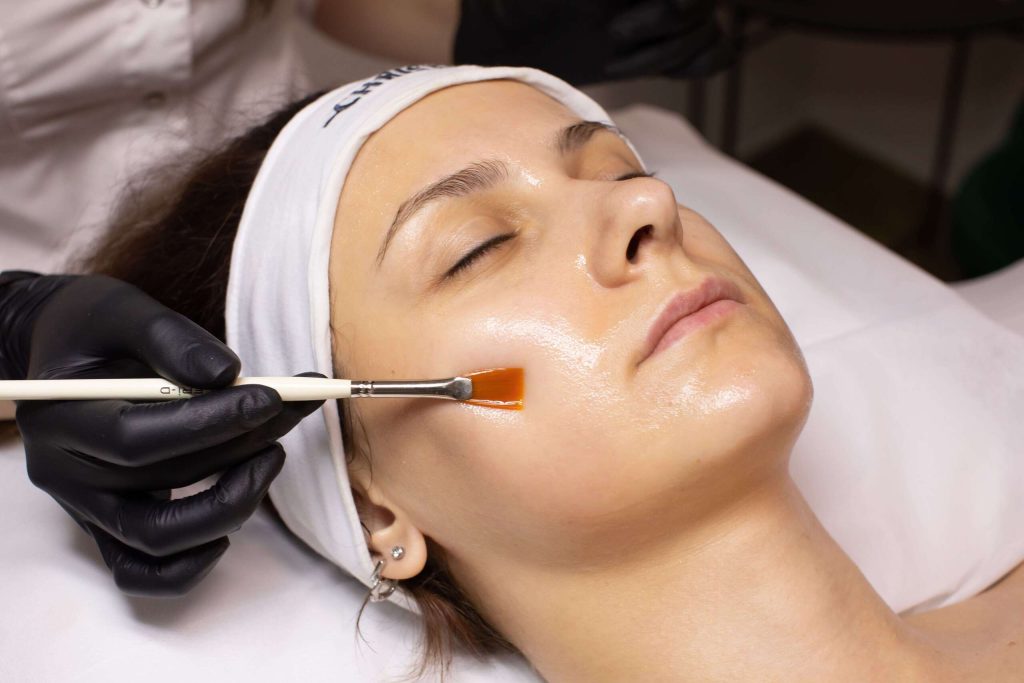 chemical peel toronto 02