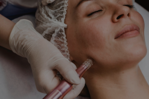 microneedling 03