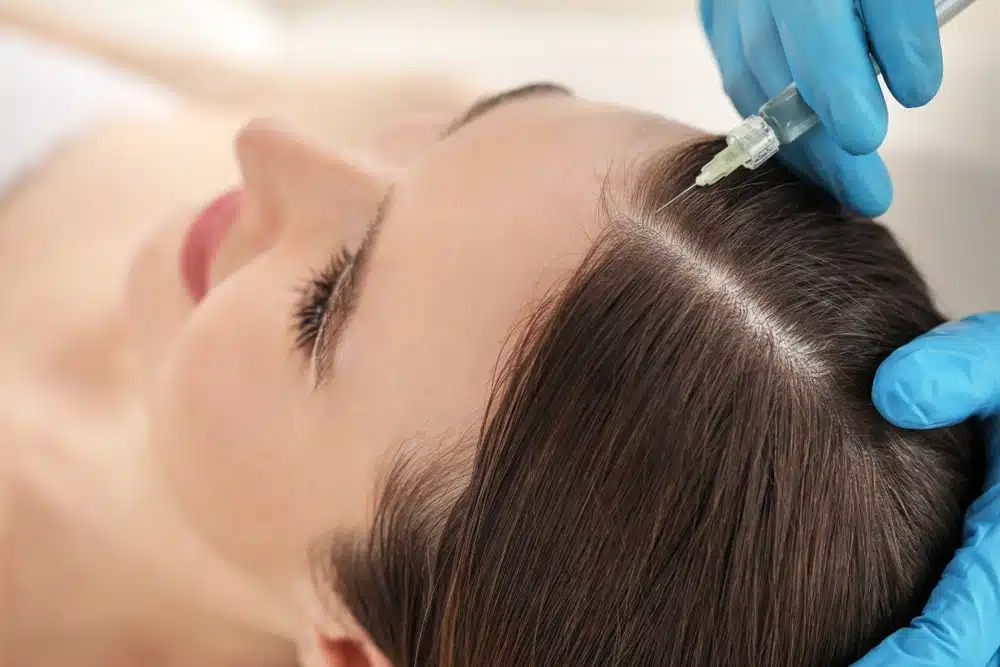 PRP Therapy for Hair Loss