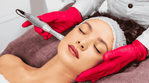 microneedling for acne scar