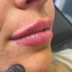 lip treatment