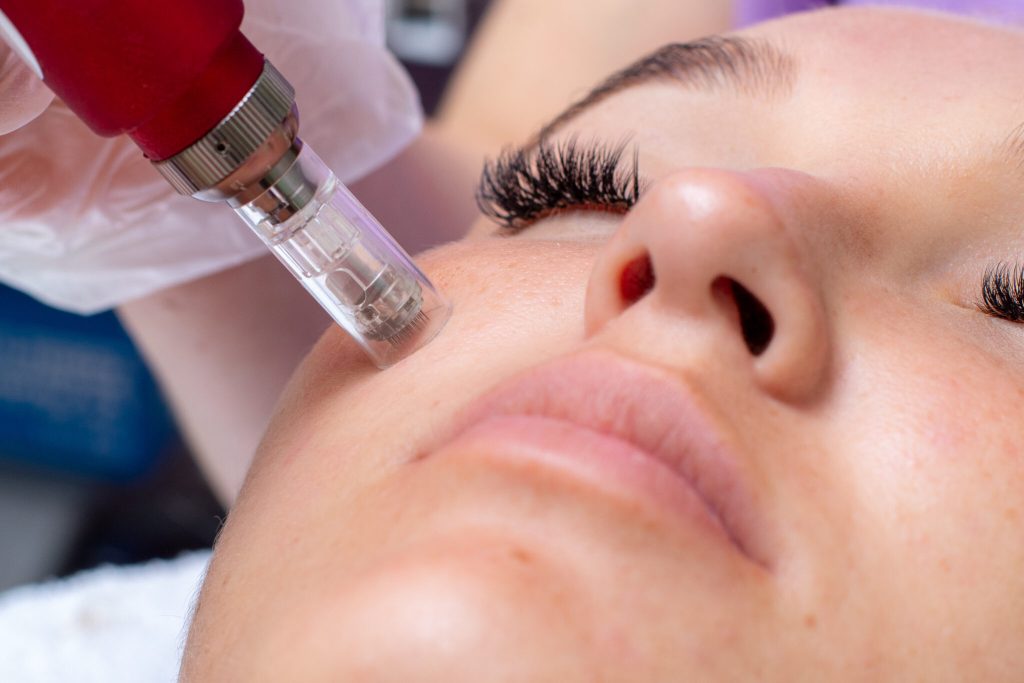 acne scars treatment