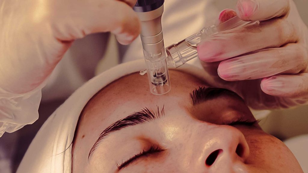 Microneedling Treatment