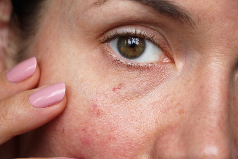 Spider Vein Removal 01