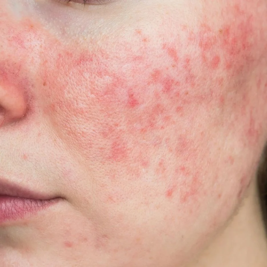 Spider Vein Removal 03