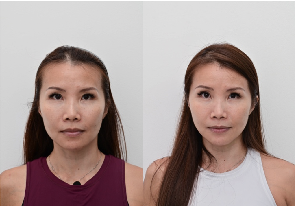before and after treatment