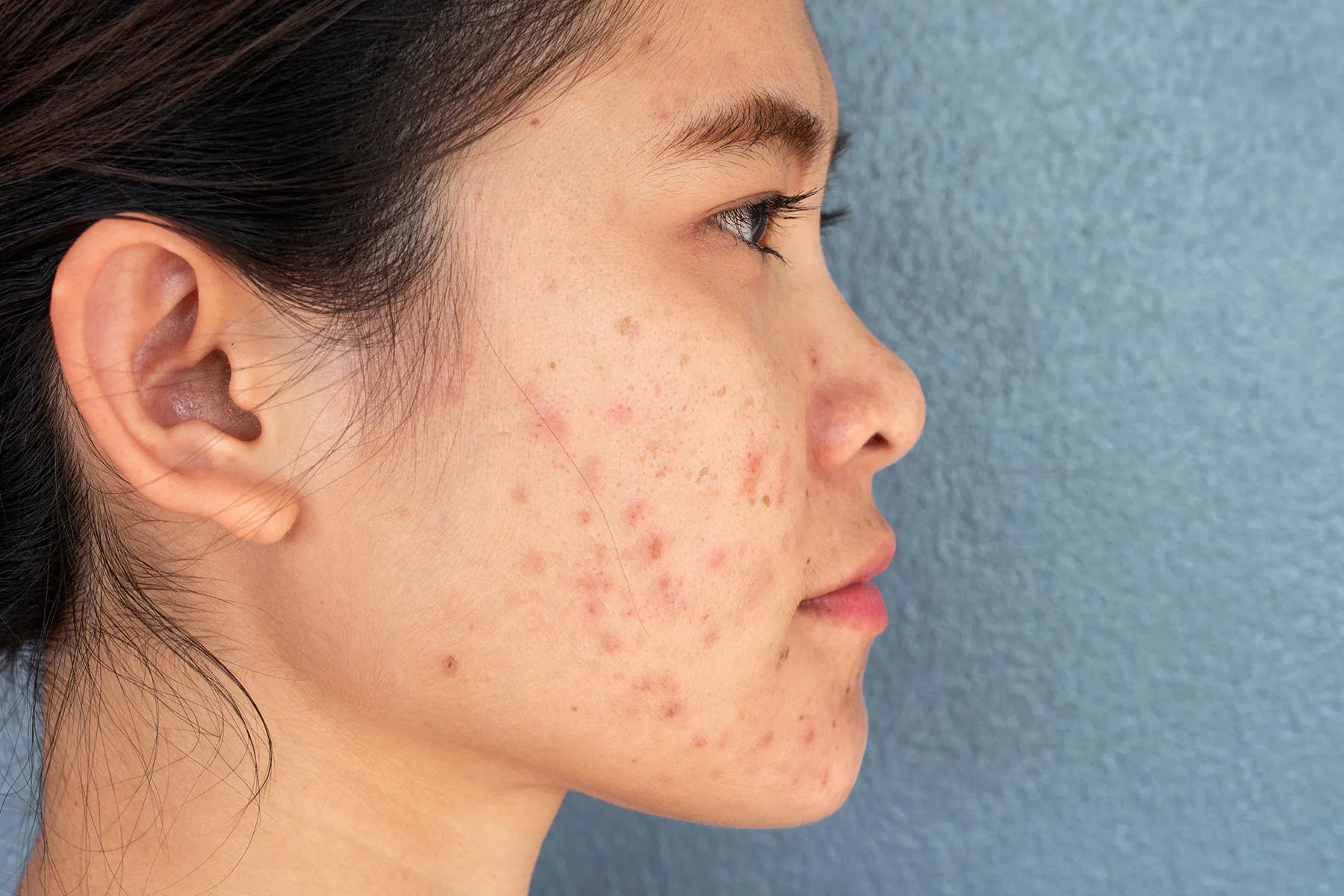 acne scars