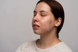 treatment for acne scars