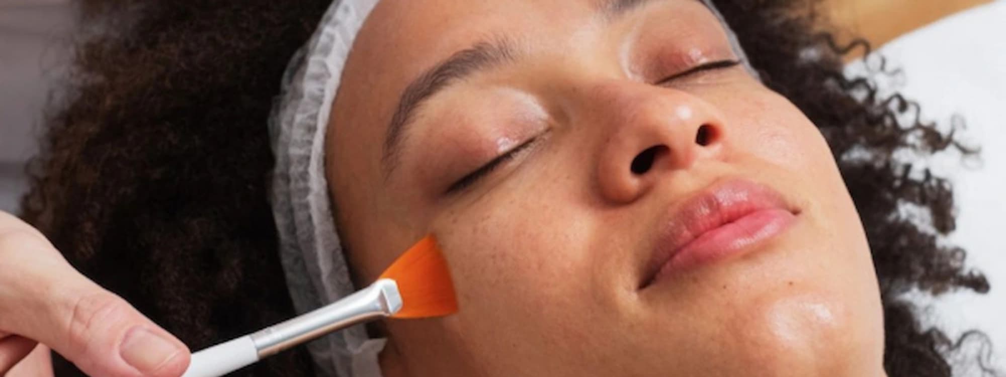 Acne Scar SERVICES 3