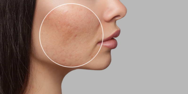 Acne Scar SERVICES 7 ghvhbh