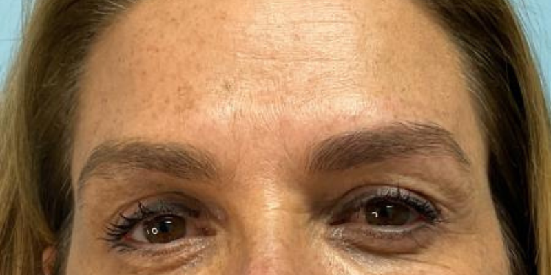 Masseter Botox 11 ghvhh