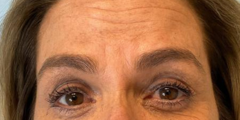 Masseter Botox 10 jhygyhghy