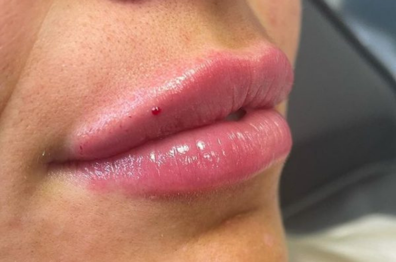 Lip Fillers Near Me 4 jknbjkbnj