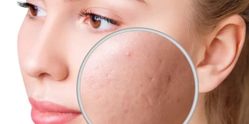 Acne Scar SERVICES 5 jnhjbhjb