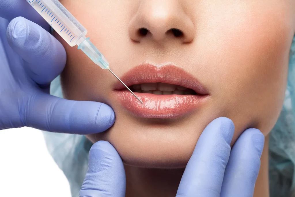 radiesse lip fillers featured