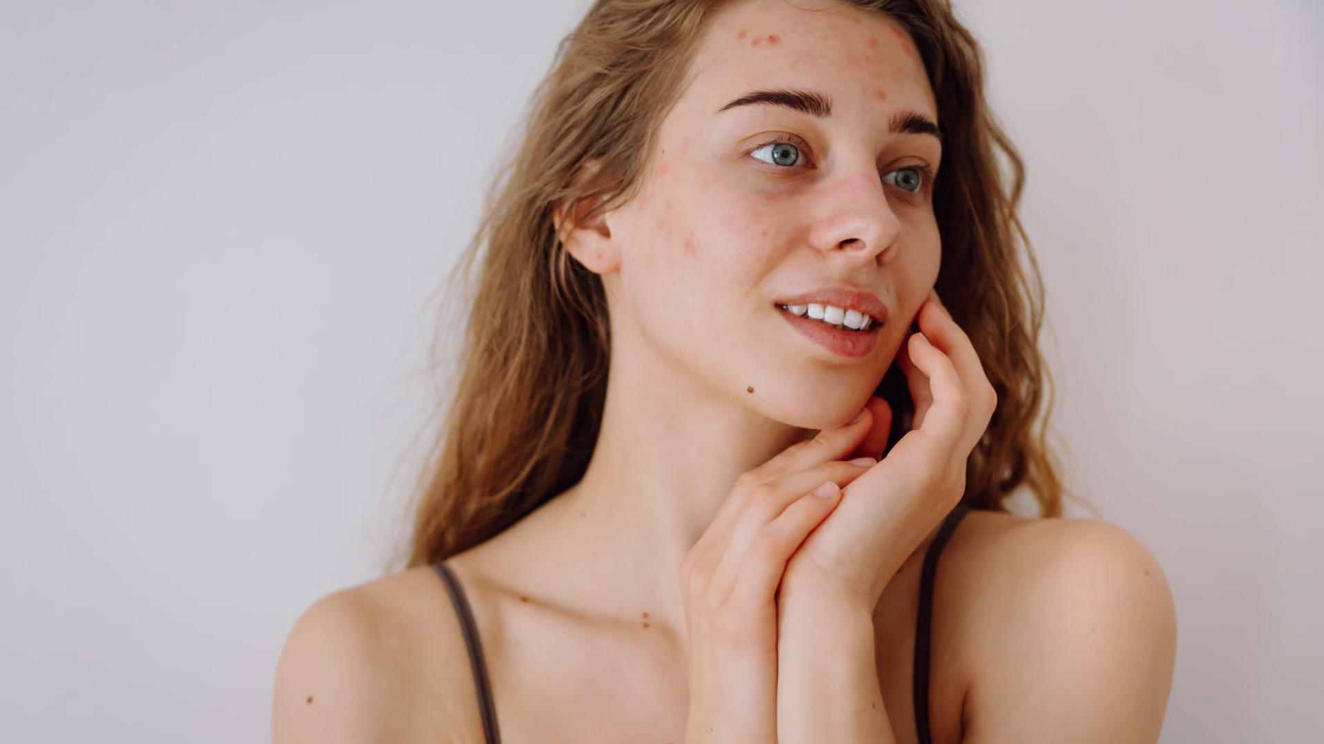 Acne scars treatment