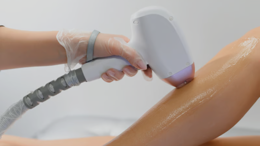 Laser hair removal