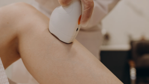 laser hair removal