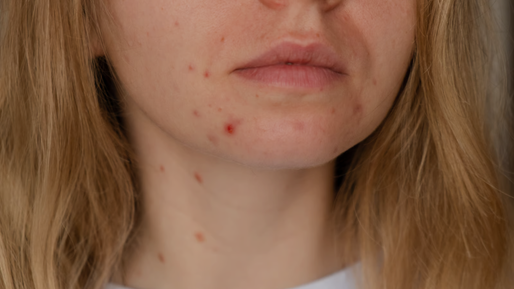 Acne scars treatment