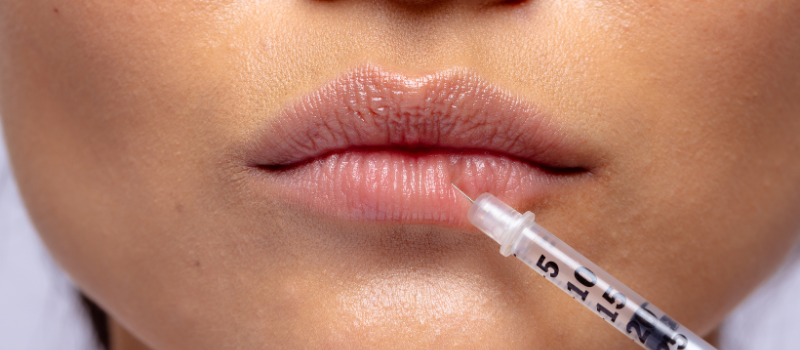 Radiesse Dermal Filler Toronto 7 ddfsdfd