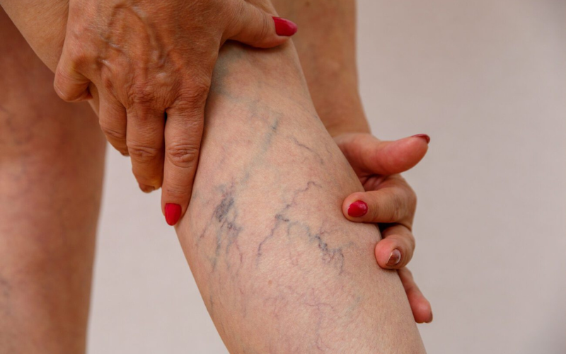 Spider Vein Removal (Sclerotherapy) 7 yjugjuhhgki