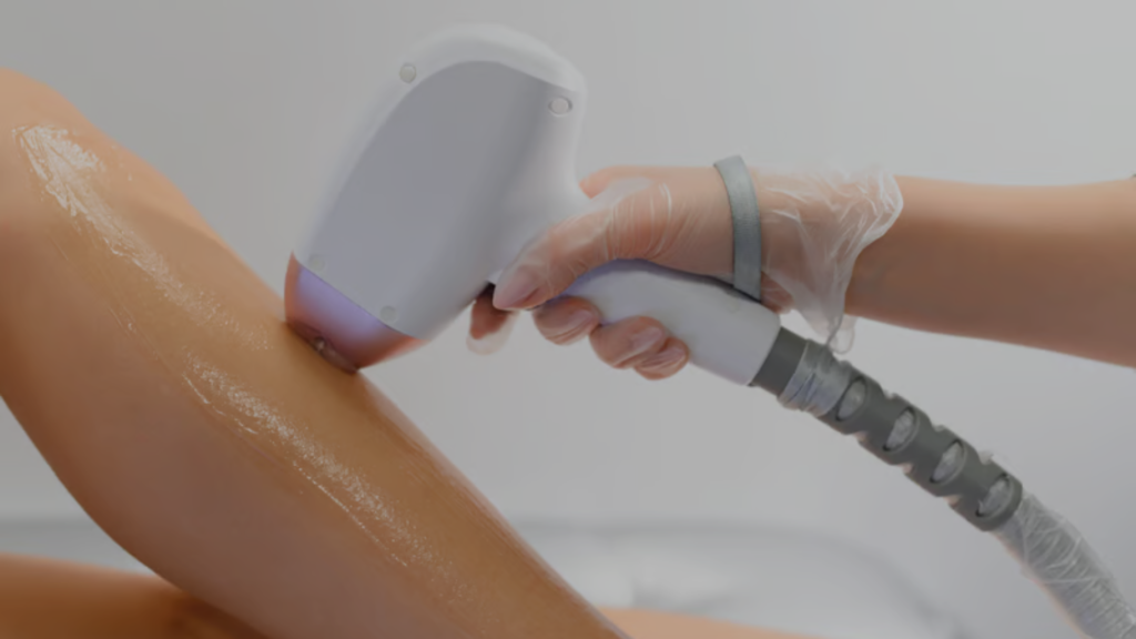 Laser hair removal