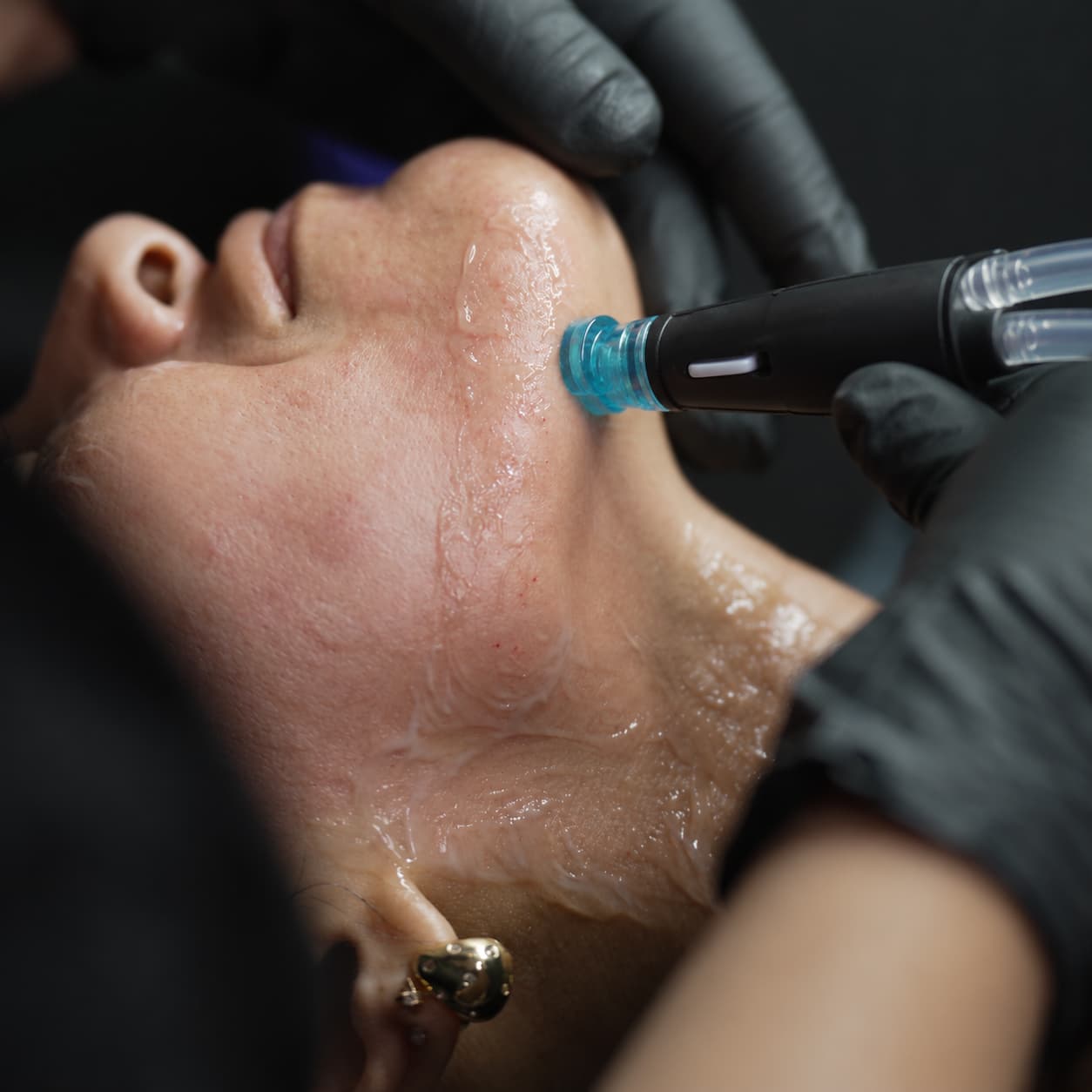 HydraFacial Skin Concerns 03 Chin