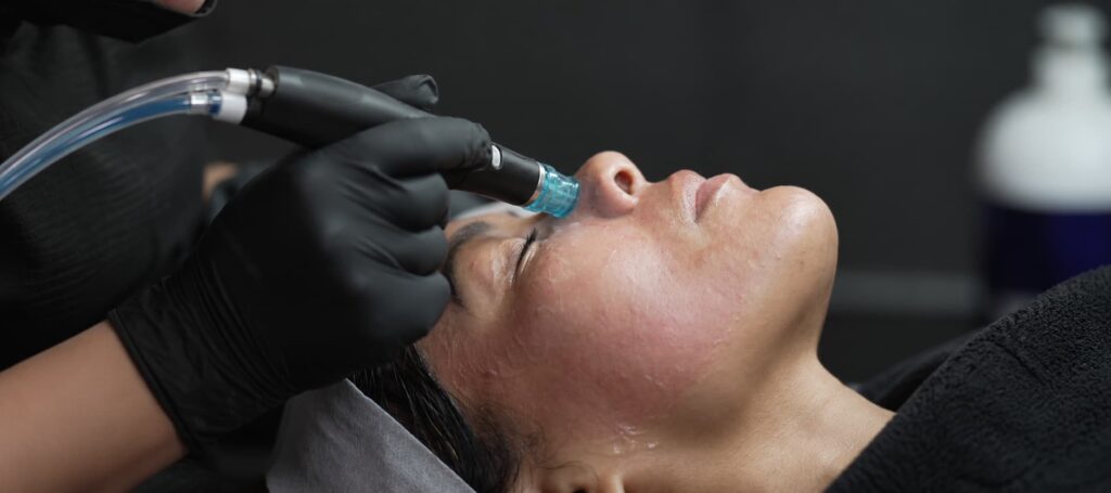 HydraFacial Step 2 Extract